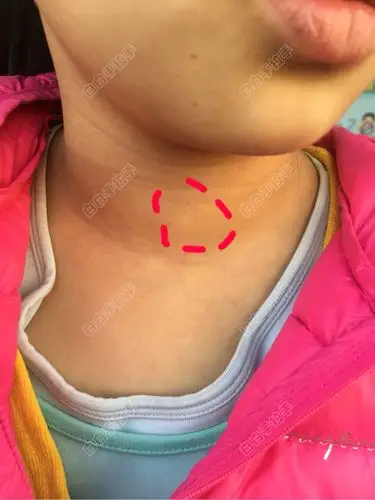 偶然发现女儿的脖子上有个白点,大家帮我看看是不是白白啊?