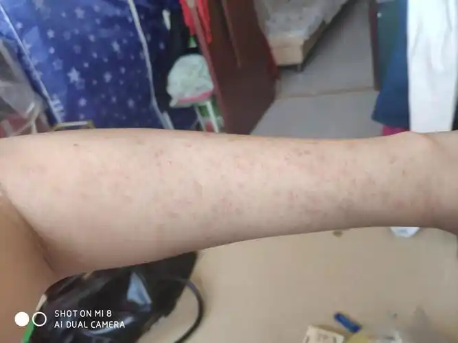 一热胳膊上就起斑点,冬天不热的时候要好很多,有没