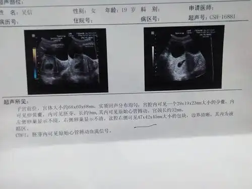 宝妈们,我怀孕45天做b超检查发现盆腔右侧可见47毫米大小包块怎么回事