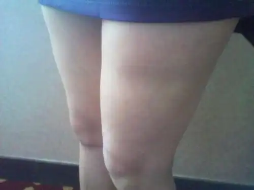 大腿肌肉萎缩怎么办造成腿部肌肉萎缩的原因