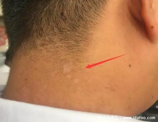 皮肤色素减退形成的白斑图片,白癜风/白化病/汗斑/白色糠疹