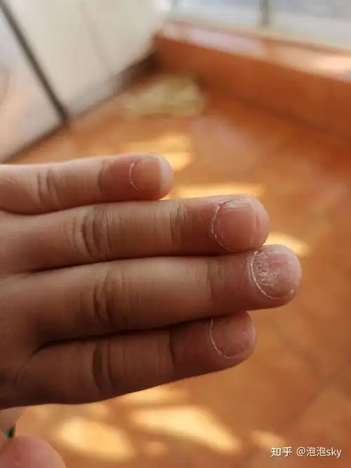 孩子指甲凹凸不平,检查微量元素是正常的,这是怎么回事.万能的知乎.