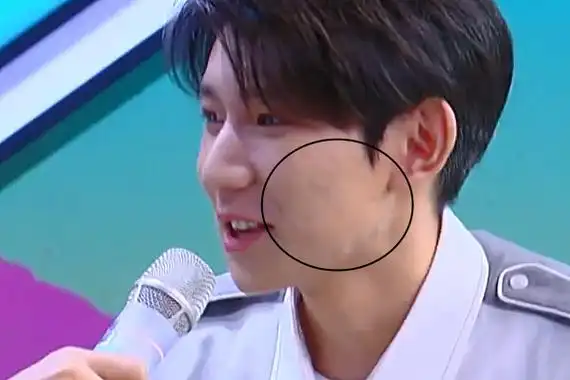 王源脸上的痘痘越发严重从脸颊长到耳根快本的美颜都拯救不了