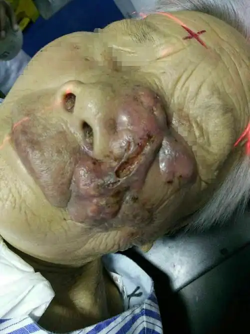 放弃?治疗?～～放疗为肿瘤患者带来希望!