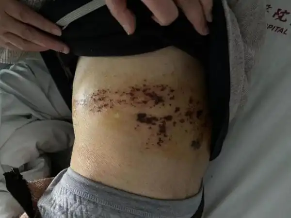 九旬老人患上蛇缠腰春季警惕这种好发病