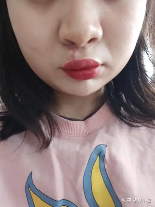 手术是中国医学科学院整形外科做的医生是宋涛医生,手术费是一万多