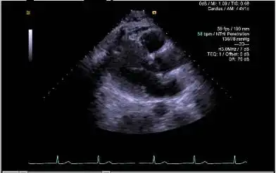 为了让读者更直观地理解b超显示的图像,这里为大家晒晒笔者的心脏检查