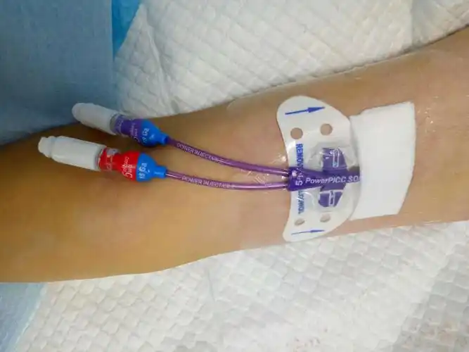 全科医疗科首例耐高压picc导管置入成功