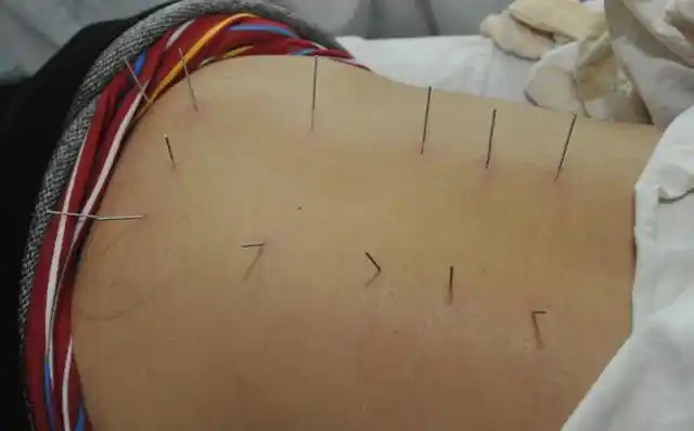 中医肿瘤专家李忠教授中医治癌症之针灸治癌