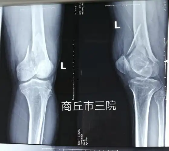 股骨髁间粉碎性骨折(c2型)