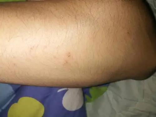 在医院实习被针扎了,我想查有没有被感染艾滋,好久可以查的出来?