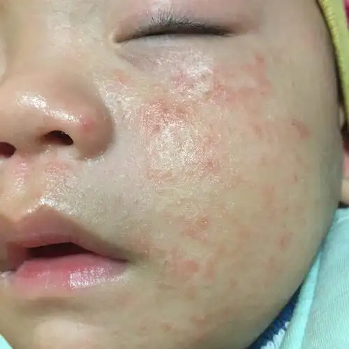 去诊所有的说说出麻疹 有的说是湿疹.