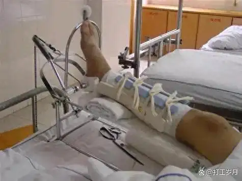 骨折手术前有多遭罪?我用我5天牵引的经历告诉你什么叫非人折磨