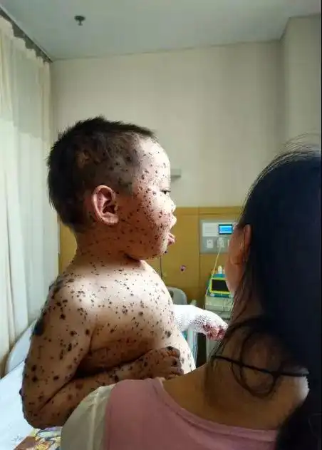 "斑点宝宝"近况:在北大国际医院刚刚接受完手术