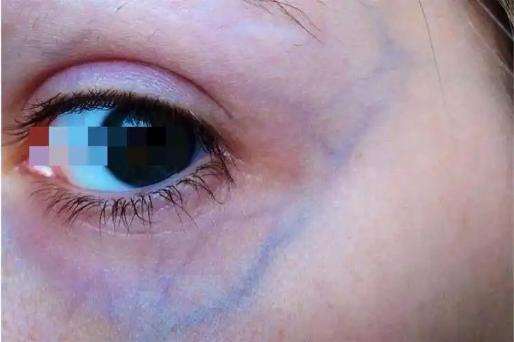 血管型黑眼圈图片