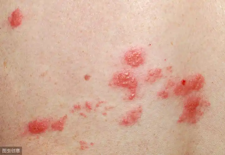 癣的种类与辨别图片一文读懂各种癣的诊断预防与治疗
