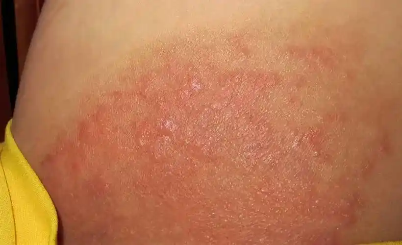 以为是皮肤病去体检,才发现原来自己感染了梅毒,目前已经在第二期