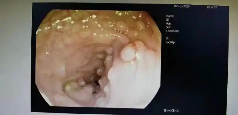 福州23岁妙龄女,每年切下几十枚息肉!这种家族性遗传病太可怕