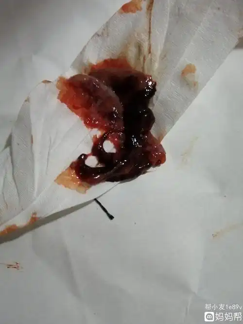 1,怀孕初期如果出现阴道出血可能是先兆流产的现象,应引起女性朋友的