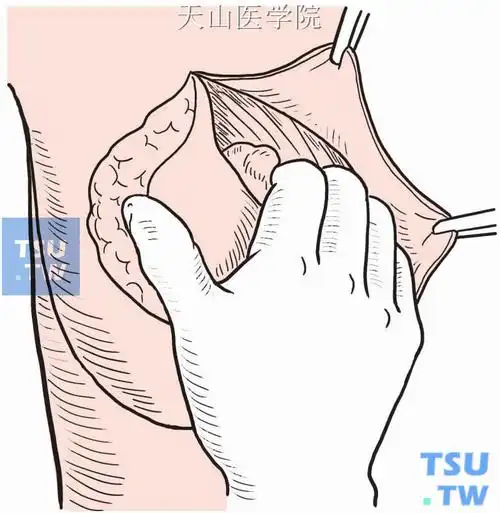 【附图】 单纯乳房切除术 _外科手术学 | 天山医学院