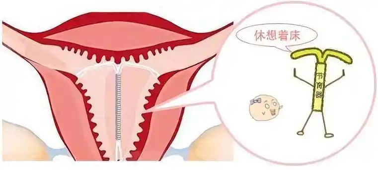 子宫的无菌性炎症,使胚胎无法在子宫内正常着床受孕,以达到避孕的目的
