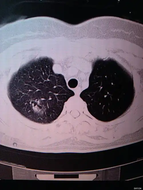 【读片】肺结核一年复查