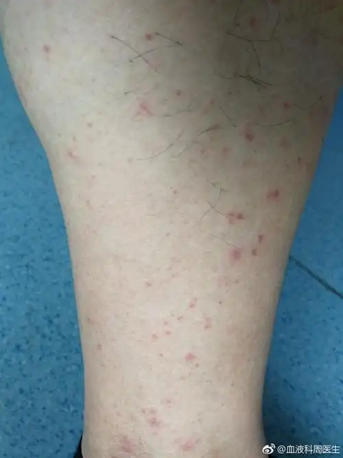 血液科医生患了过敏性紫癜