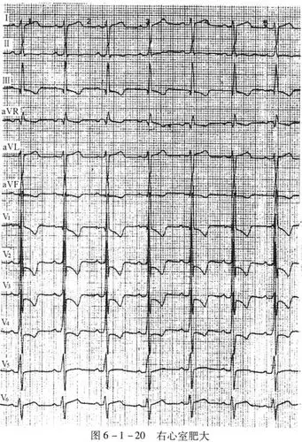 图6-1-20右心室肥大