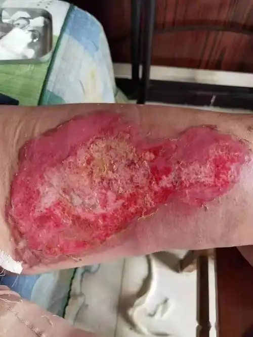 胆小勿进!一女子被电暖宝爆炸致伤!