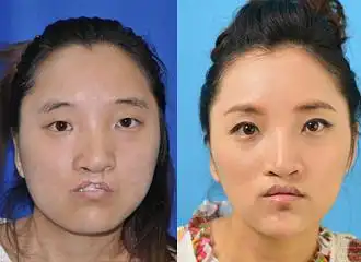 90后唇腭裂姐弟成功修复 变化好大