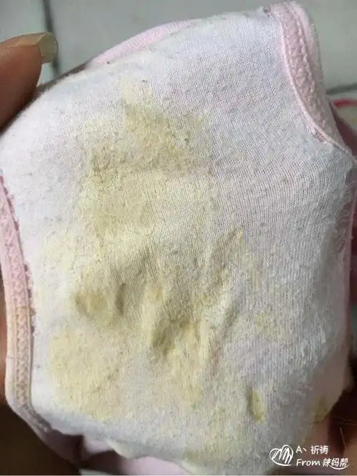 孕中期分泌物多的进