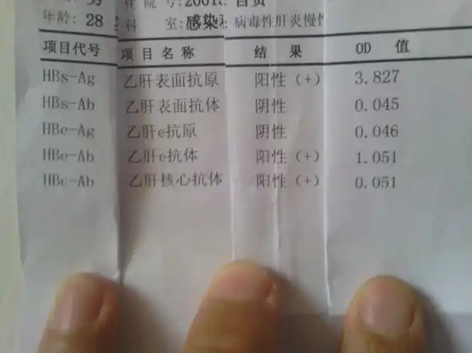 2014-06-04 刘英新 主治医师 我的乙肝化验单怎么看 求专业人士指