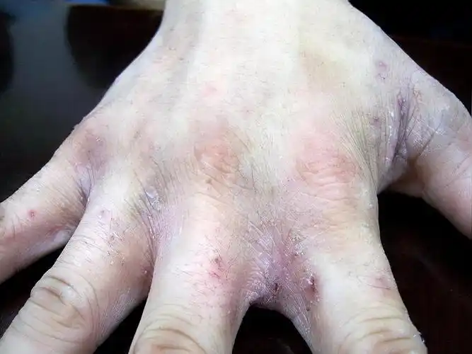 疥疮(传染性皮肤病))_石塘网