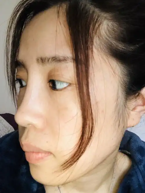 照片可能不太明显.但是山根处明显高一块,别人一眼就能看出来是假的.