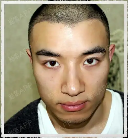 m型发际线的形成原因是什么样呢71