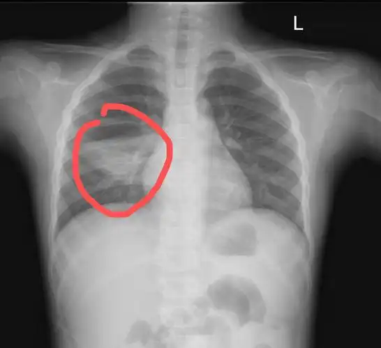 中医院放射科带您解读小儿肺炎