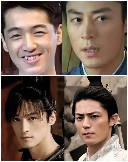 胡歌是右上凸出一颗牙齿,霍建华是左下凹进去一颗牙齿.