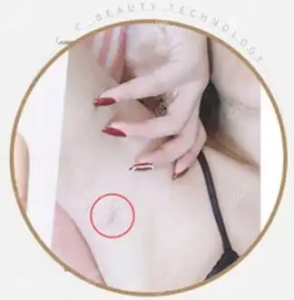 赖明忠医生做假体隆胸的切口为2cm