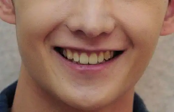 因此牙齿发黄实在是很正常的现象,大家不要觉得是自己邋遢,连你的小