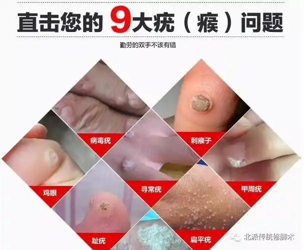 疣的诊断及鉴别