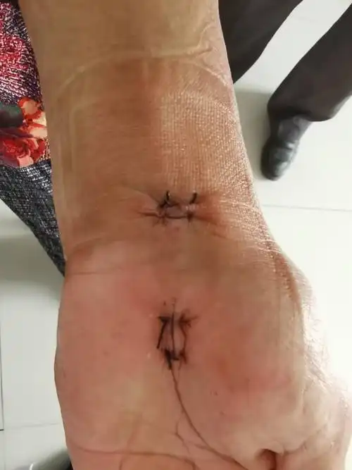 术后切口愈合良好,无渗出.