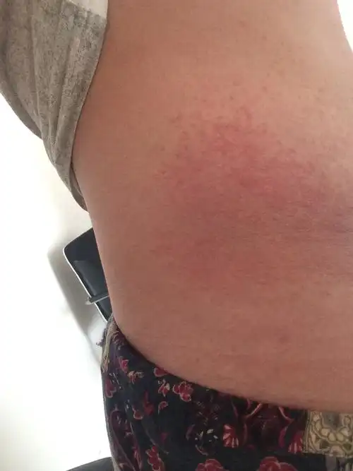 好几年了每年的夏天都准时的起主要起在腰部胸部附近特别的痒等夏