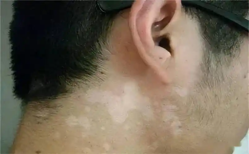 汗斑| 身上这些白色汗斑,简单洗洗就能除掉?_皮肤_黄瓜_艾灸理