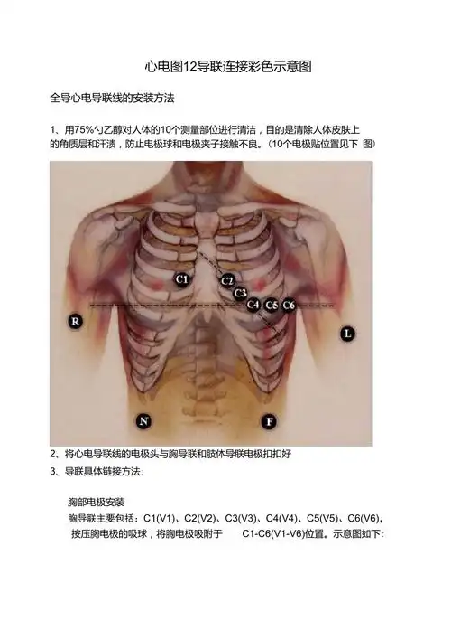 心电图12导联连接彩色示意图
