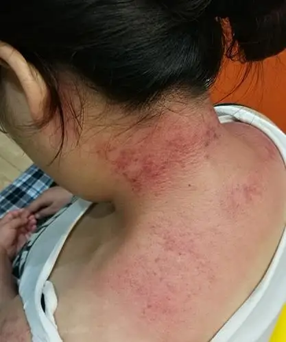 95公斤女孩停经50天问题出在哪