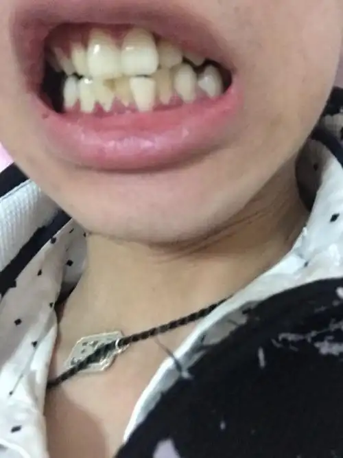 我这兔牙要怎么做牙齿矫正,还有下面那颗. 而且牙齿咬合也不齐.