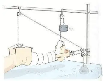 10 分钟了解骨科牵引术