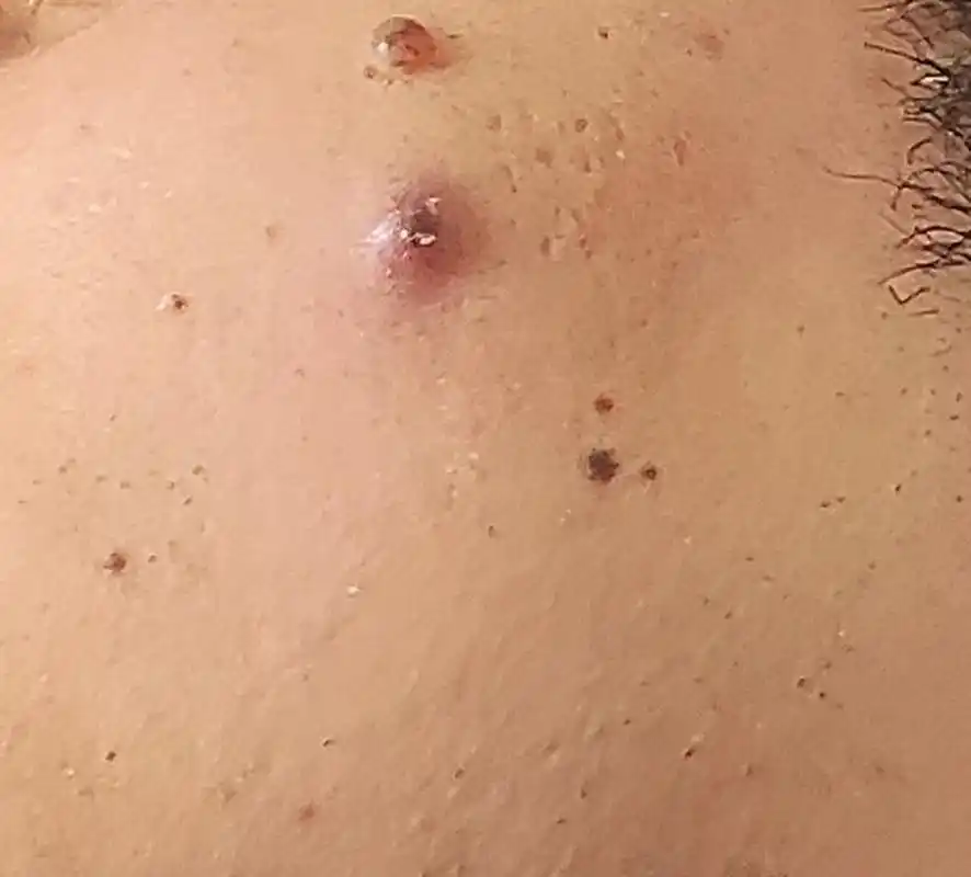 老公脸上鼓了一个肿包,我怀疑是皮肤癌,这两天是周末也见不了大夫,他