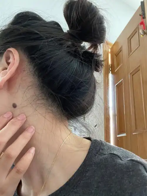 脖子里的大黑痣从小到大就有