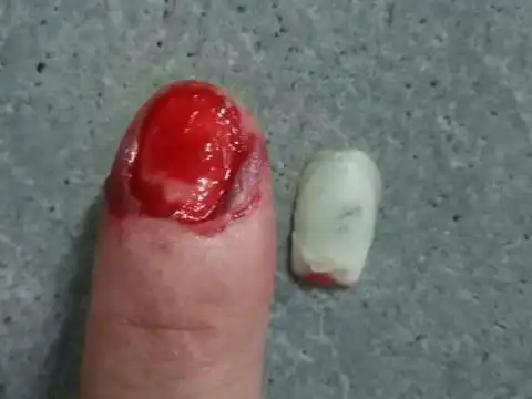 梦见指甲盖出血